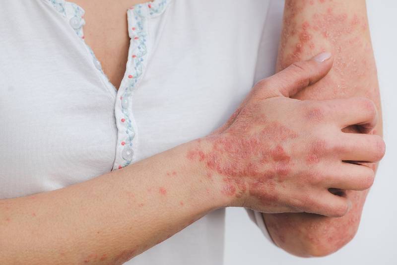 Causes of Psoriasis Featured Image