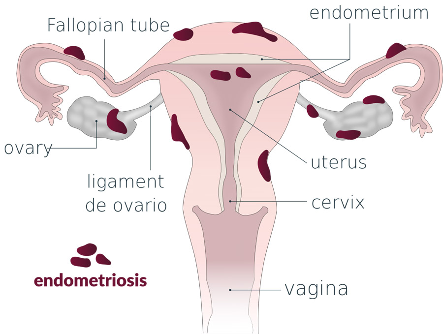 Endometriosis Overview
