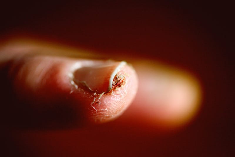 What Is Nail Psoriasis