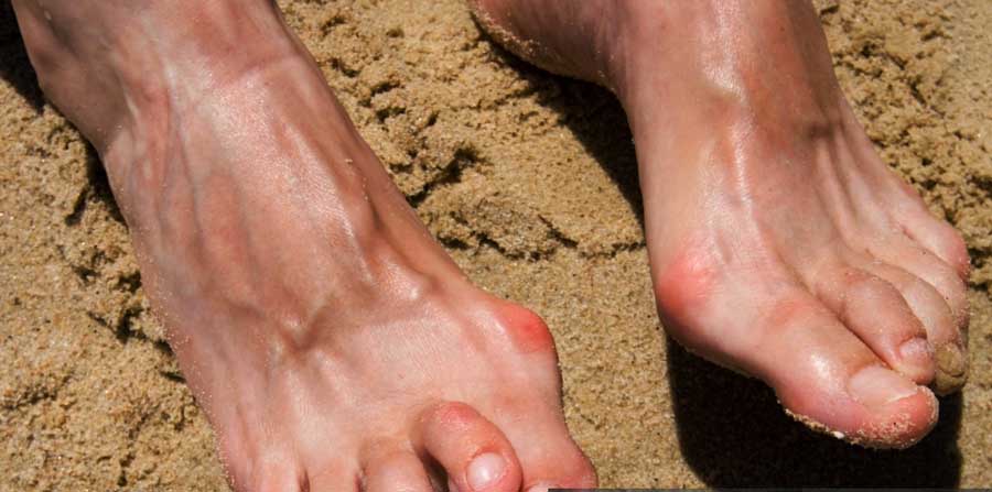 What is a hammertoe? Causes, symptoms and treatment - OMA - Oh My Arthritis