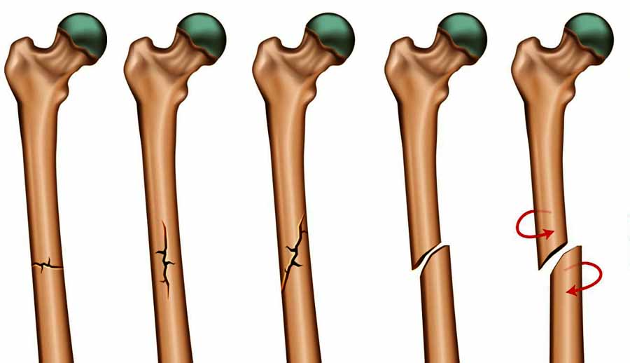 What Is Greenstick Fracture? - Klarity Health Library